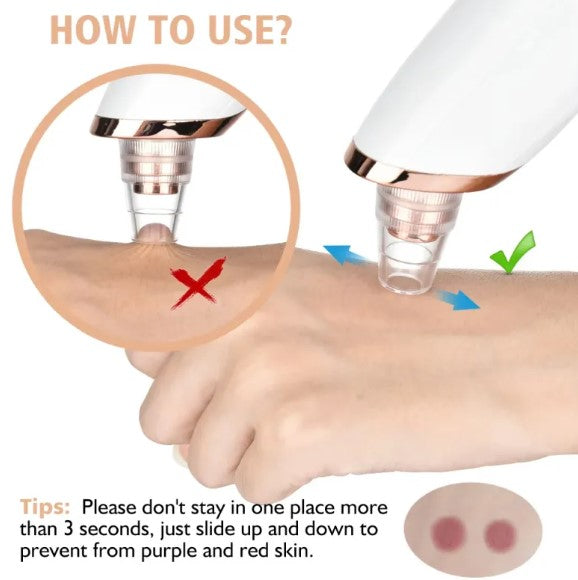 Novix™ Blackhead Remover