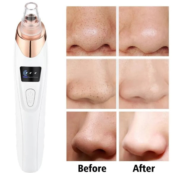 Novix™ Blackhead Remover