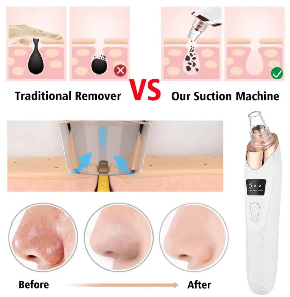 Novix™ Blackhead Remover